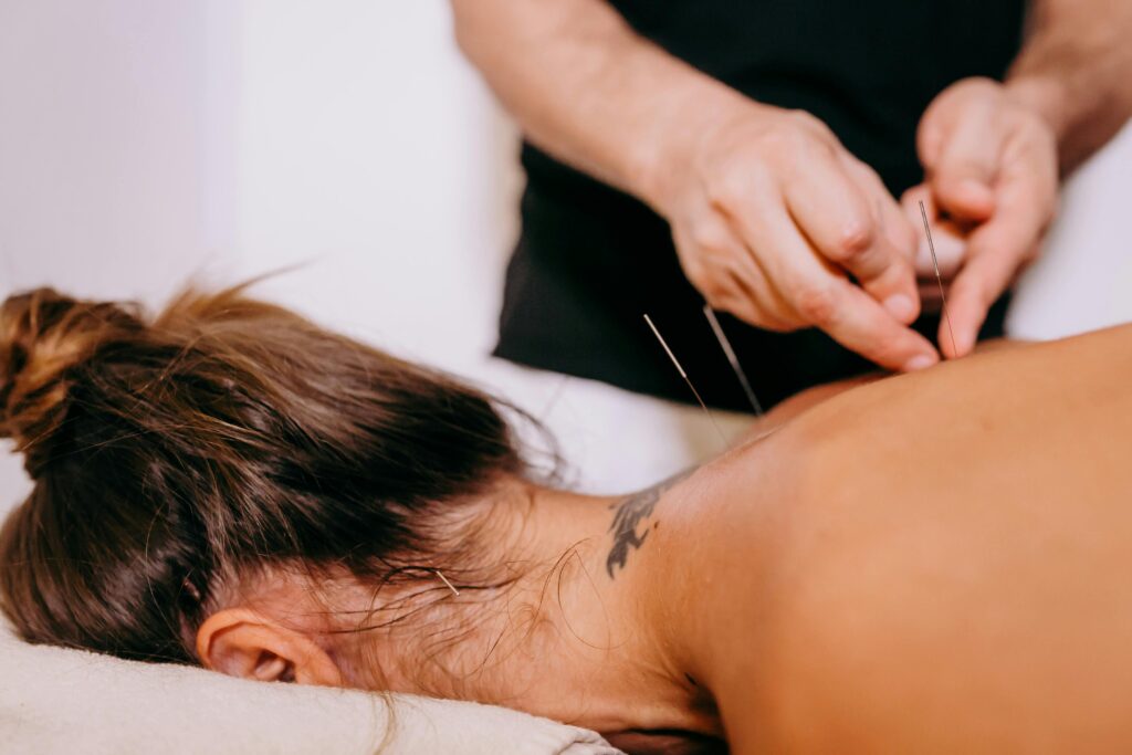 acupuncture needles being inserted on a woman's back during therapy, promoting relaxation and wellness.